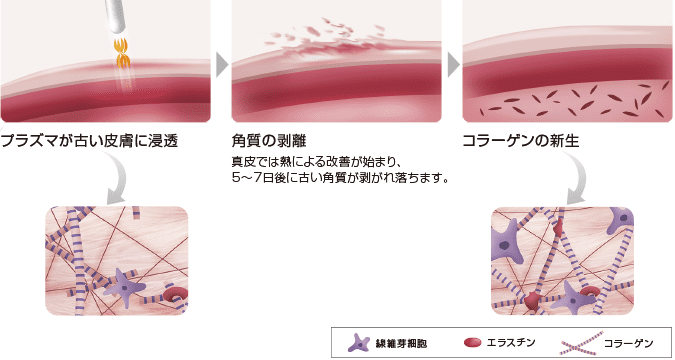 プラズマ